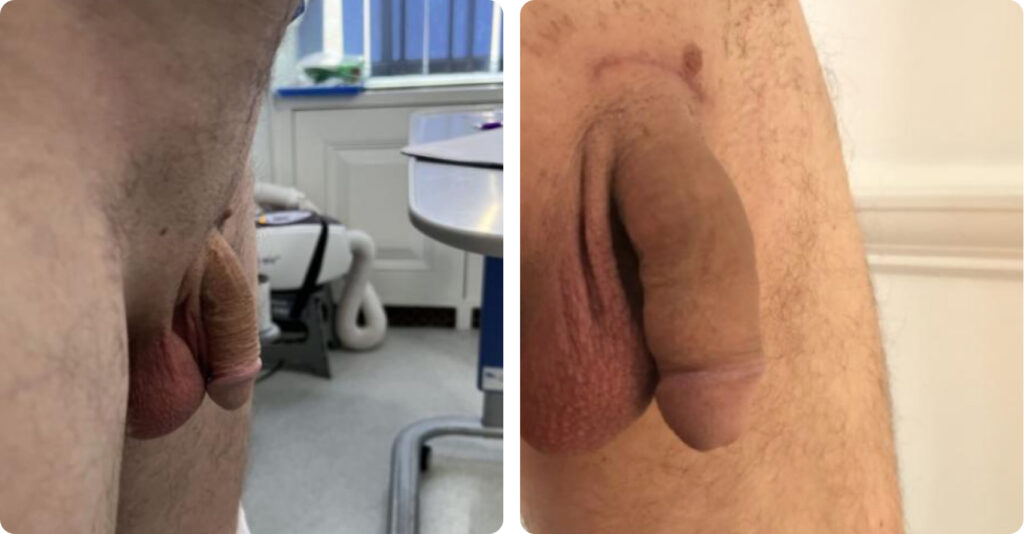 penis enlargement surgery before and after