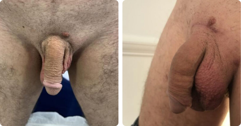 penis enlargement surgery before and after